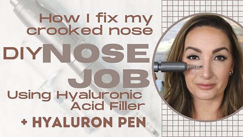 NOSE JOB w/ a hyaluron pen and hyaluronic acid filler