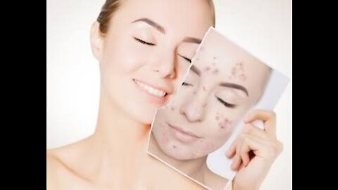 Blackheads removel