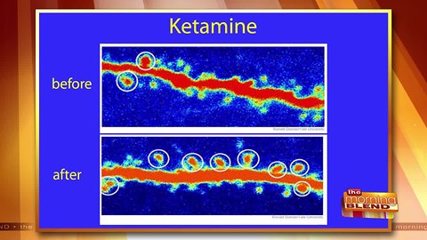 Breakthrough Treatment for Depression & PTSD