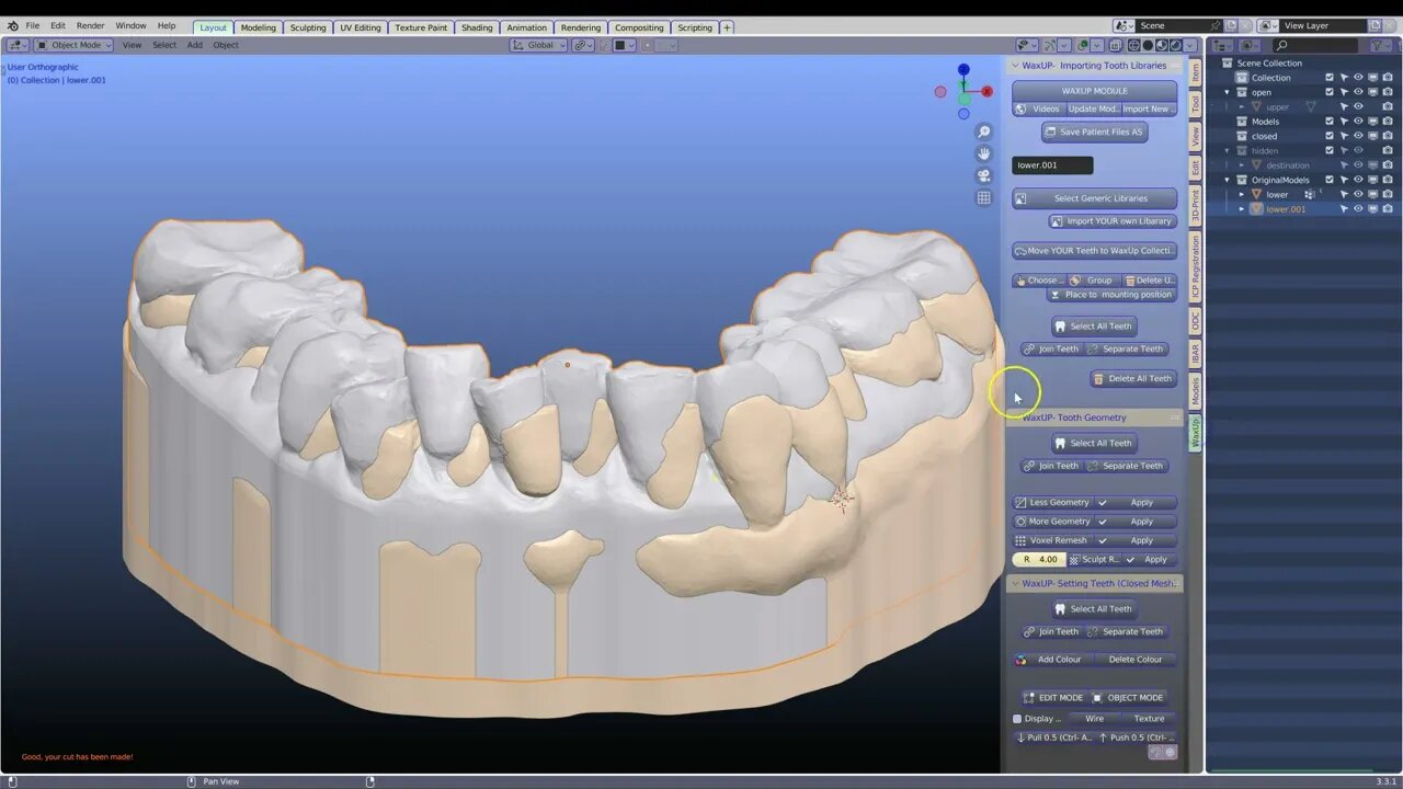 Raising the occlusion.