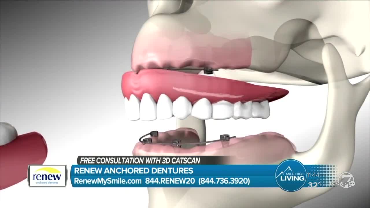 FREE Consultation and CAT Scan - Renew Anchored Dentures
