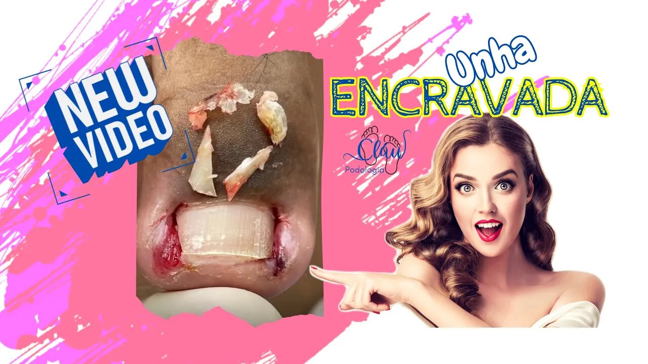 Unha encravada? Não sofra mais!! #unhaencravada #podologia #nails #ingrown_toenail