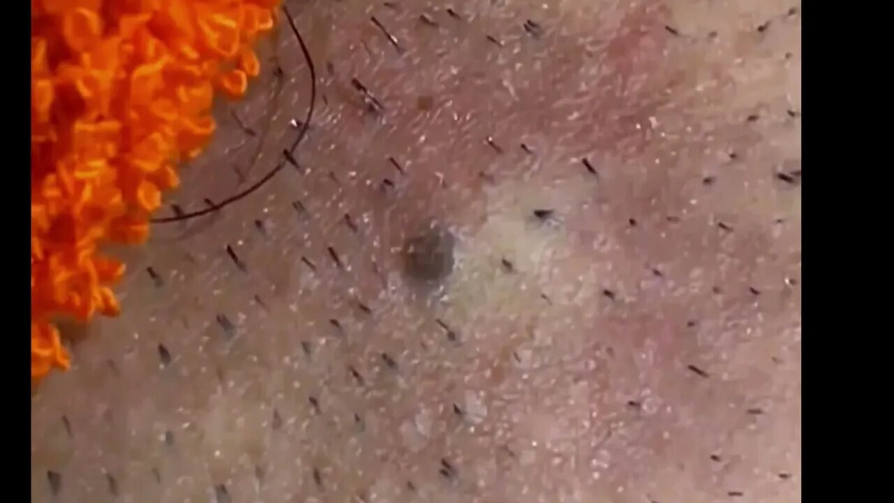 BLACKHEADS REMOVAL SATISFYING Remoção de Cravos Negros Profundos e Gigantes Blackhead Ex