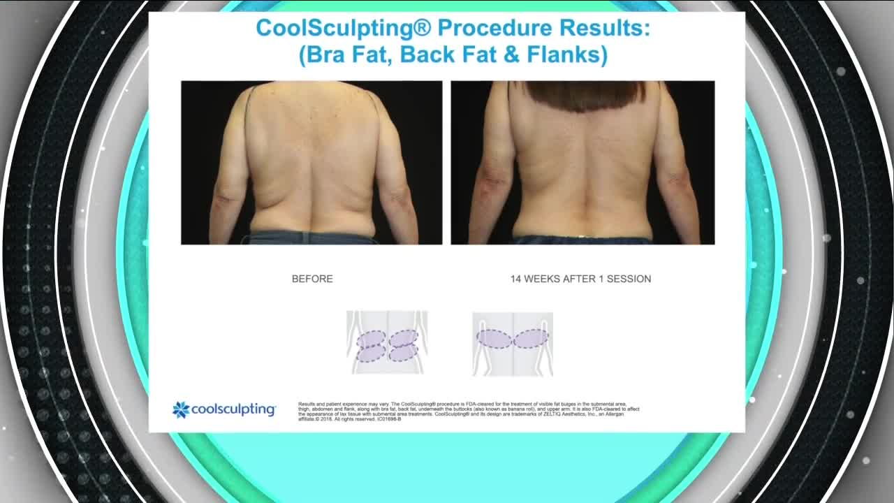 Denver Coolsculpting, Soundwave & Microneedling // MD Body & Med Spa