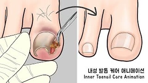 SATISFYING I ASMR Ingrown Toenal