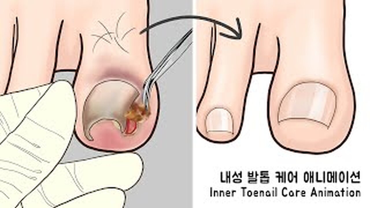 SATISFYING I ASMR Ingrown Toenal