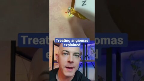 Amazing laser treatment on angiomas!!