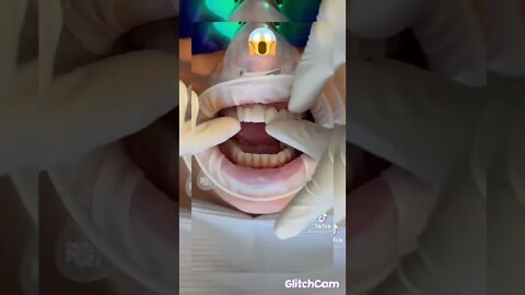 how to fix tooth gap in two minutes#shorts#fix#fast