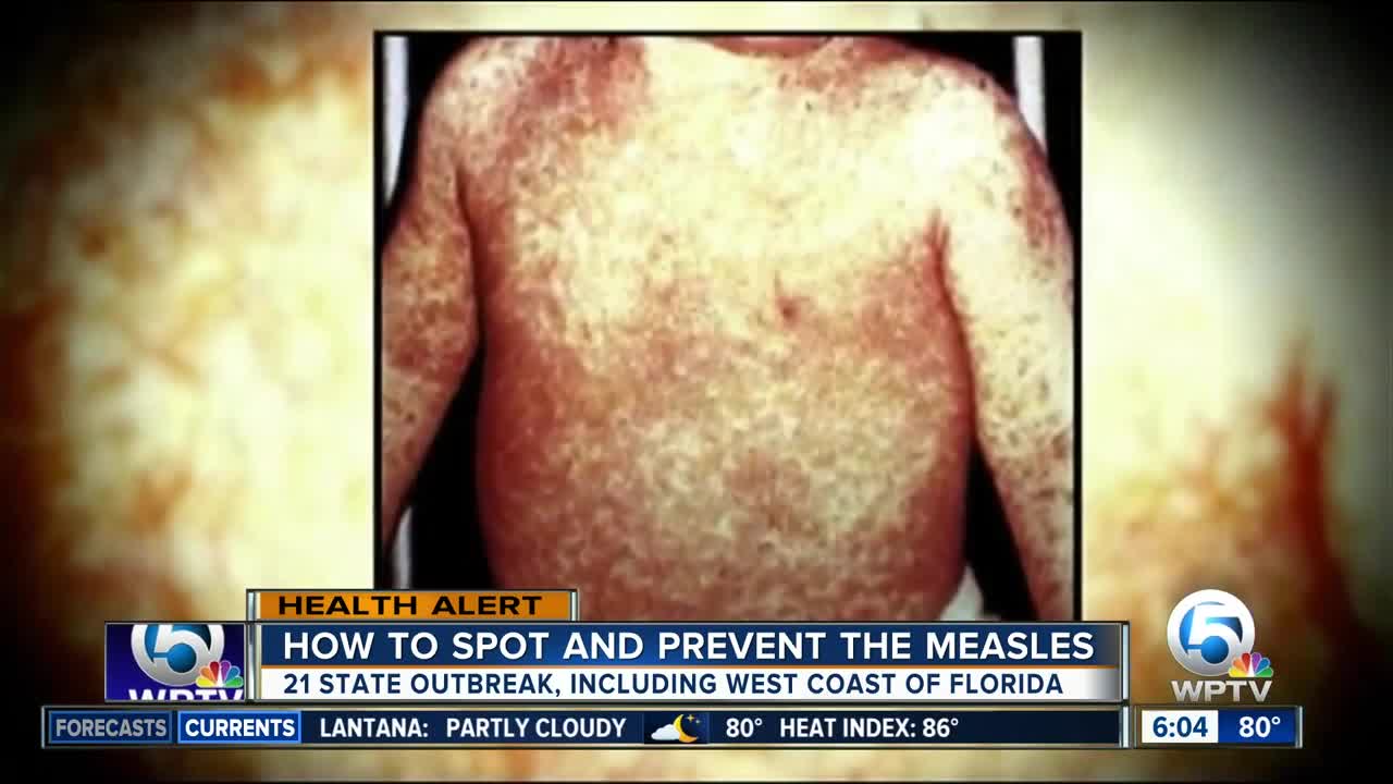 New cases brings measles count to 3 in Florida's Gulf Coast