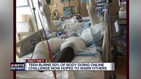 'Don't do it' Burned teen warns about fire challenge see saw online