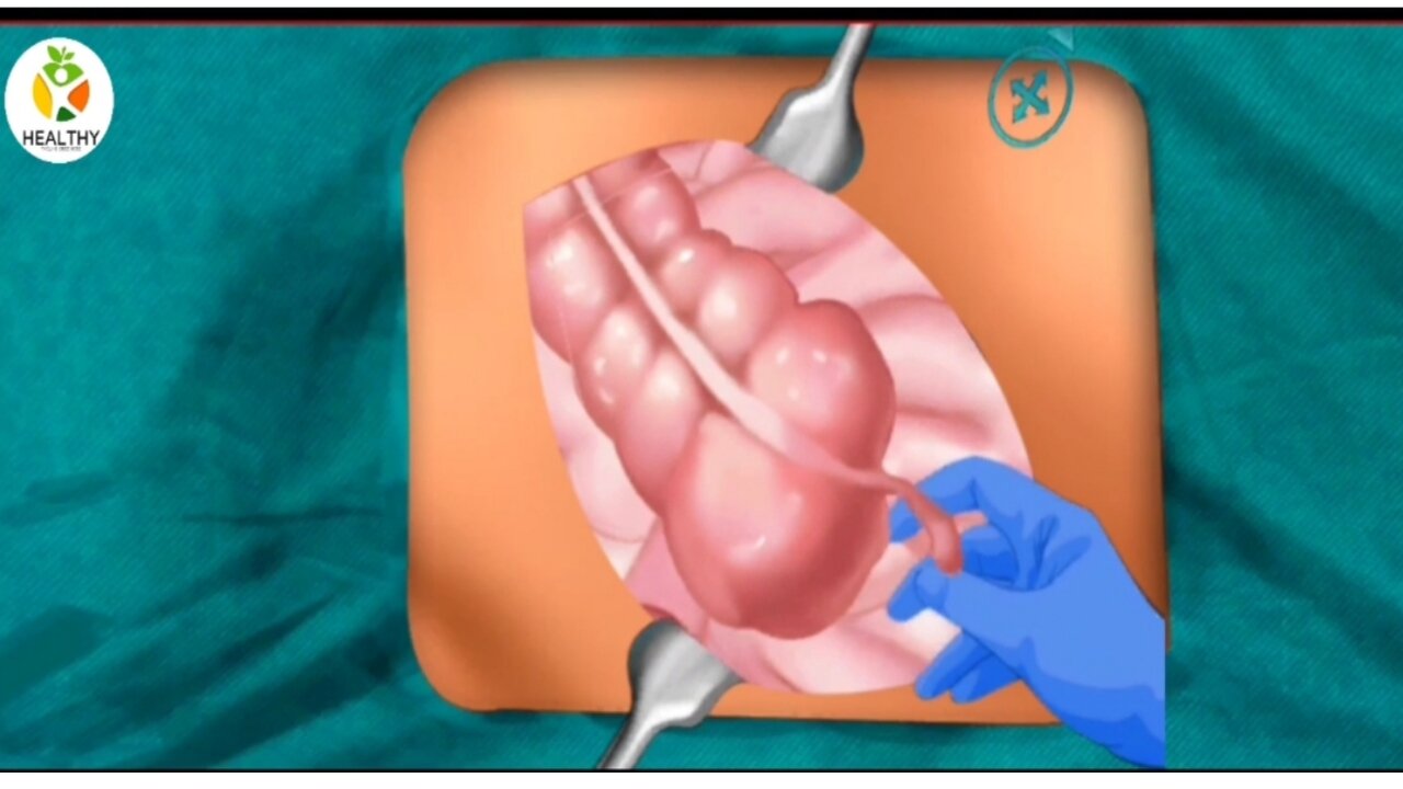 Appendix Surgery Process And Operation Video। APPENDECTOMY (Open technique) Animation video।