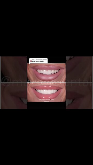 Dental And Teeth Hygiene