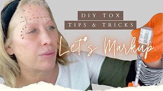 Tox for Upper Face, Crowsfeet and Brow Lift