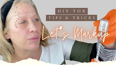 Tox for Upper Face, Crowsfeet and Brow Lift