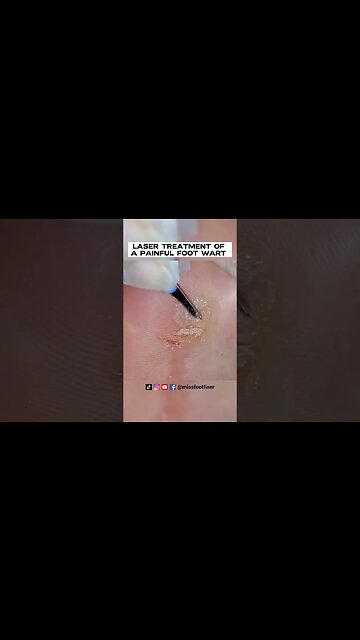 LASER TREATMENT OF A PAINFUL FOOT WART / VERRUCA [2023] BY FAMOUS FEETT SPECIALIST MISS FOOT FIXER