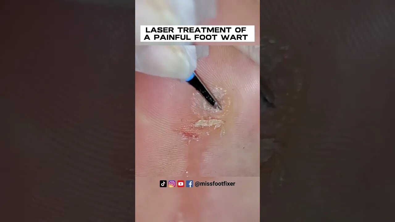 LASER TREATMENT OF A PAINFUL FOOT WART / VERRUCA [2023] BY FAMOUS FEETT SPECIALIST MISS FOOT FIXER