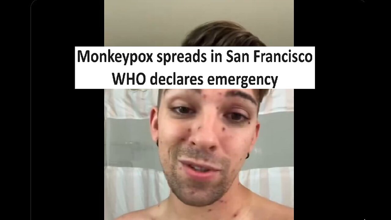 Monkeypox spreading in San Francisco WHO declared emergency in time for election