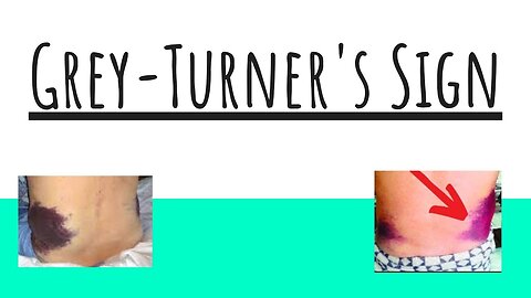 Understanding Grey-Turner's Sign | Clinical Significance and Causes