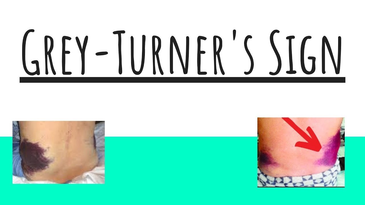 Understanding Grey-Turner's Sign | Clinical Significance and Causes