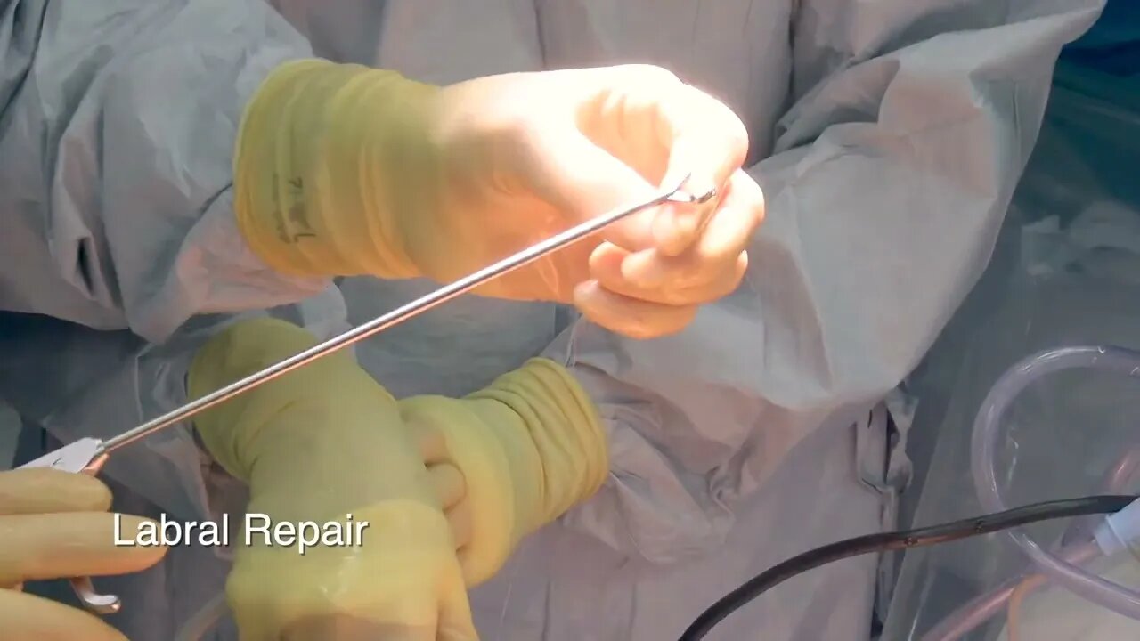 Scott A. Barbour, M.D. Completes a Acetabuloplasty