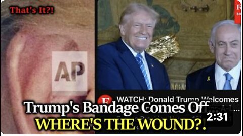 BIG REVEAL: Trump's Bandage Comes Off Showing... Minor Discoloration? Can The Gaslighting Stop Now?