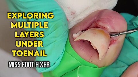 Exploring Multiple Layers Under Toenail: Causes & Treatment By Foot Specialist Miss Foot Fixer