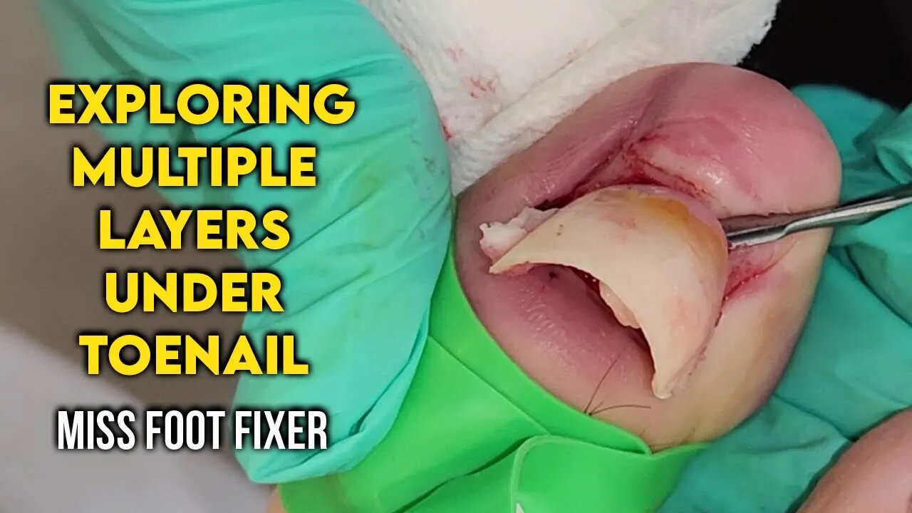 Exploring Multiple Layers Under Toenail: Causes & Treatment By Foot Specialist Miss Foot Fixer
