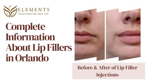 Juvederm (Ultra, & Ultra Plus) Service in Orlando | Elements Rejuvenating Med Spa