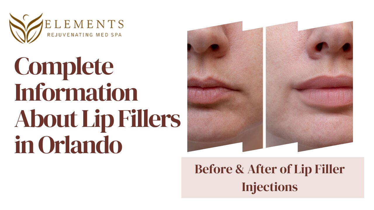 Juvederm (Ultra, & Ultra Plus) Service in Orlando | Elements Rejuvenating Med Spa