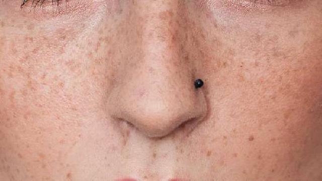 5 Things You Never Knew About Freckles