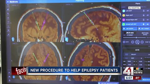 New procedure to help epilepsy patients