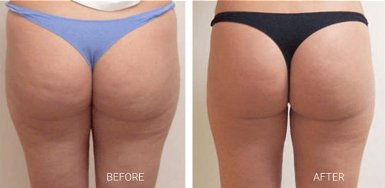 Cellulite Gone- No Weight Loss No Gym Routine