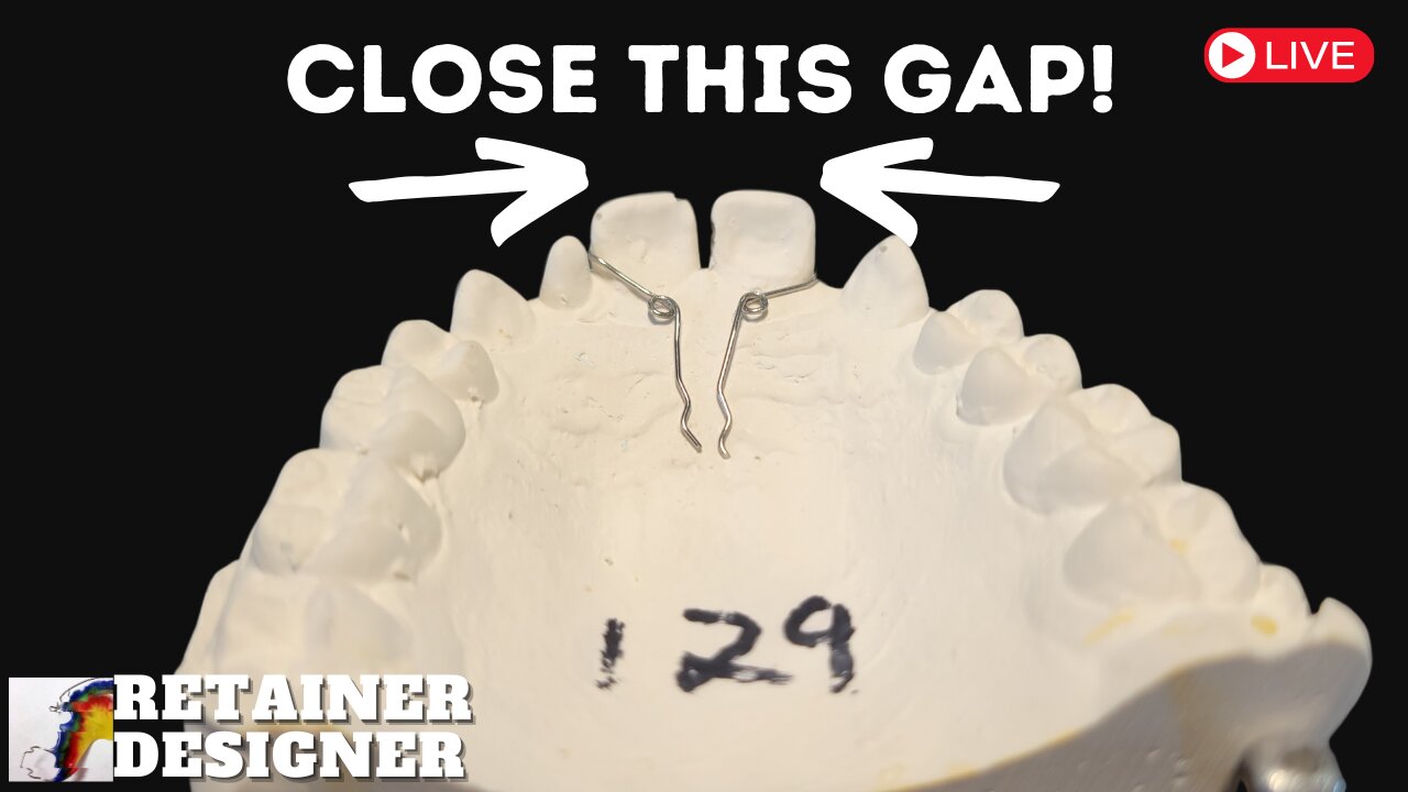 Lets make an appliance to close this Gap! Using Anterior Finger Springs on a Hawley