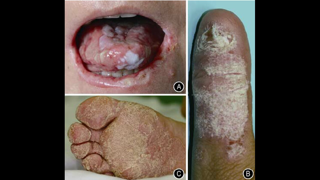 Candida albicans