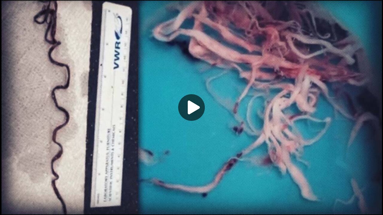 Embalmers Report Most Bodies Showing Massive Fiber Clots Likely From Covid Vaccines