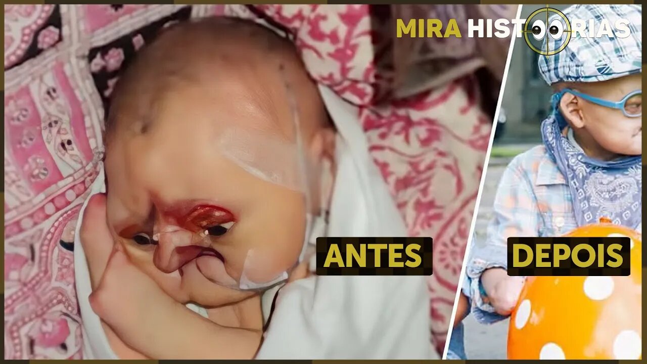 BE'BÊ FOI' ABAND0NAD0 NO H0SPITAL por ser “H0RR0R0'S0”. Então uma enfermeira o adota e o TRANS'F0RMA