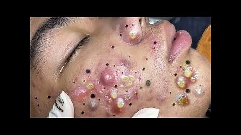 Blackheads Whiteheads Removal Dr Pimple Popper Cystic Acne Extraction