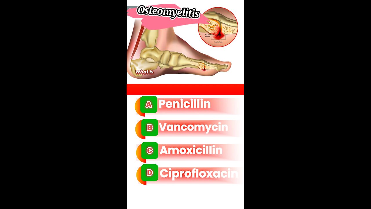 Osteomyelitis question answers mcqs #Osteomyelitis #bone #disease