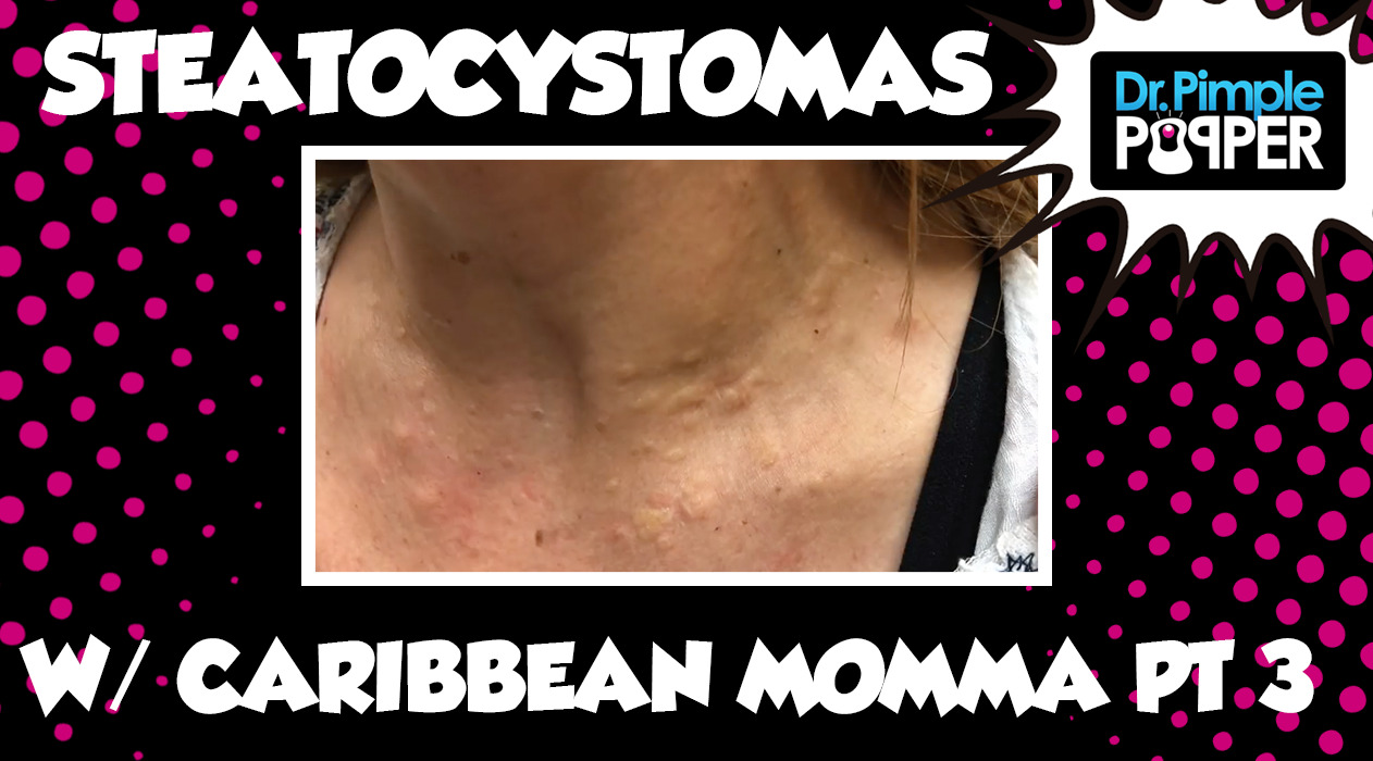 Caribbean Momma & Her Steatocystomas! Session One, Part Three