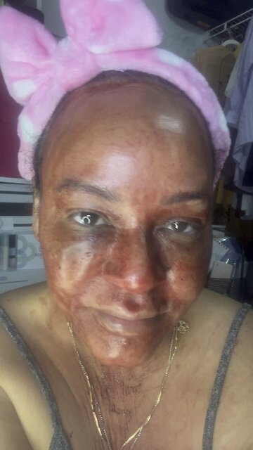 DIY vampire facial, prf