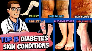 TOP 15 Diabetes Skin Signs & Symptoms [Type 2 & 1 Diabetes Mellitus]