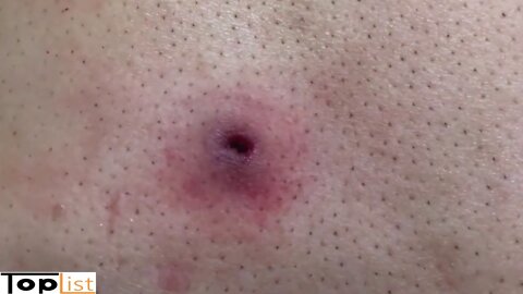 Compilation of the most horror acne squeezing #3