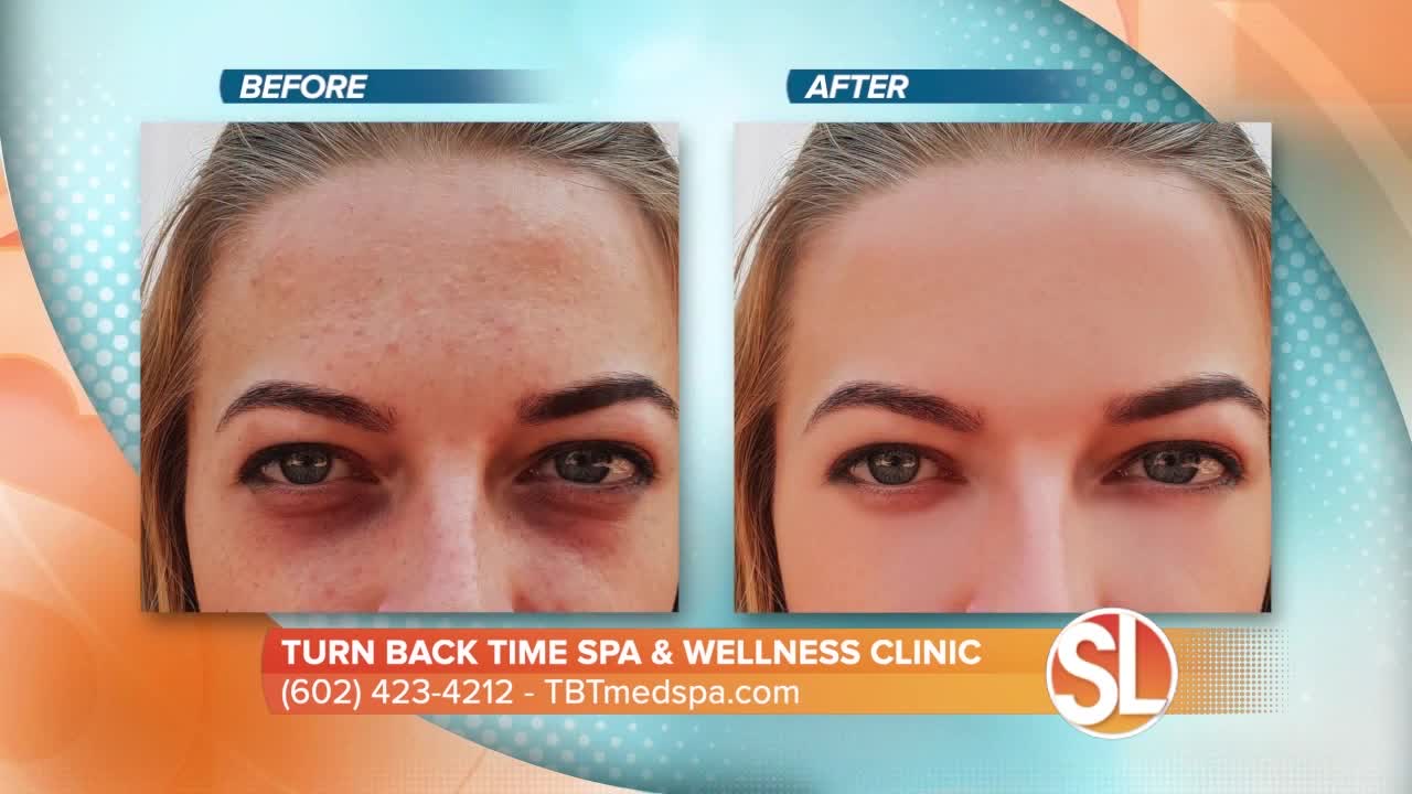 Watch how Turn Back Time Spa & Wellness Clinic can remove dark spots, age spots and much more from your skin