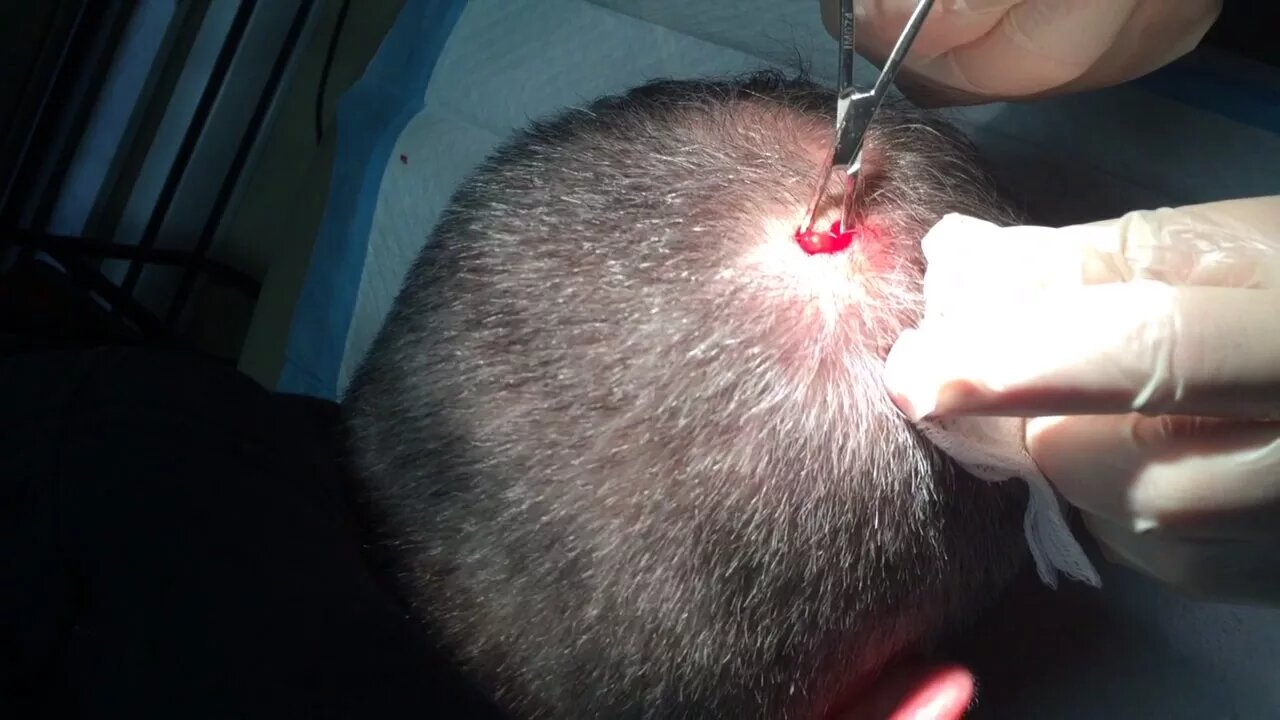 Pilar Cyst Removal from Scalp (short and sweet)