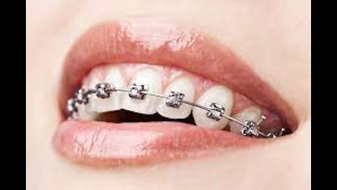 How Does the Braces Work?