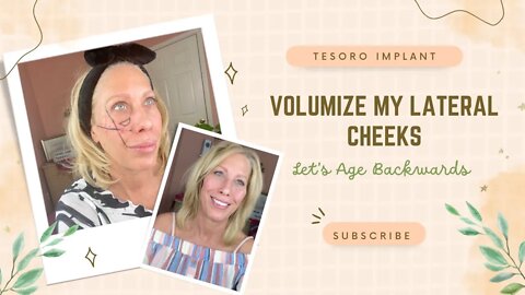 How to get Volume in Cheeks - Filler