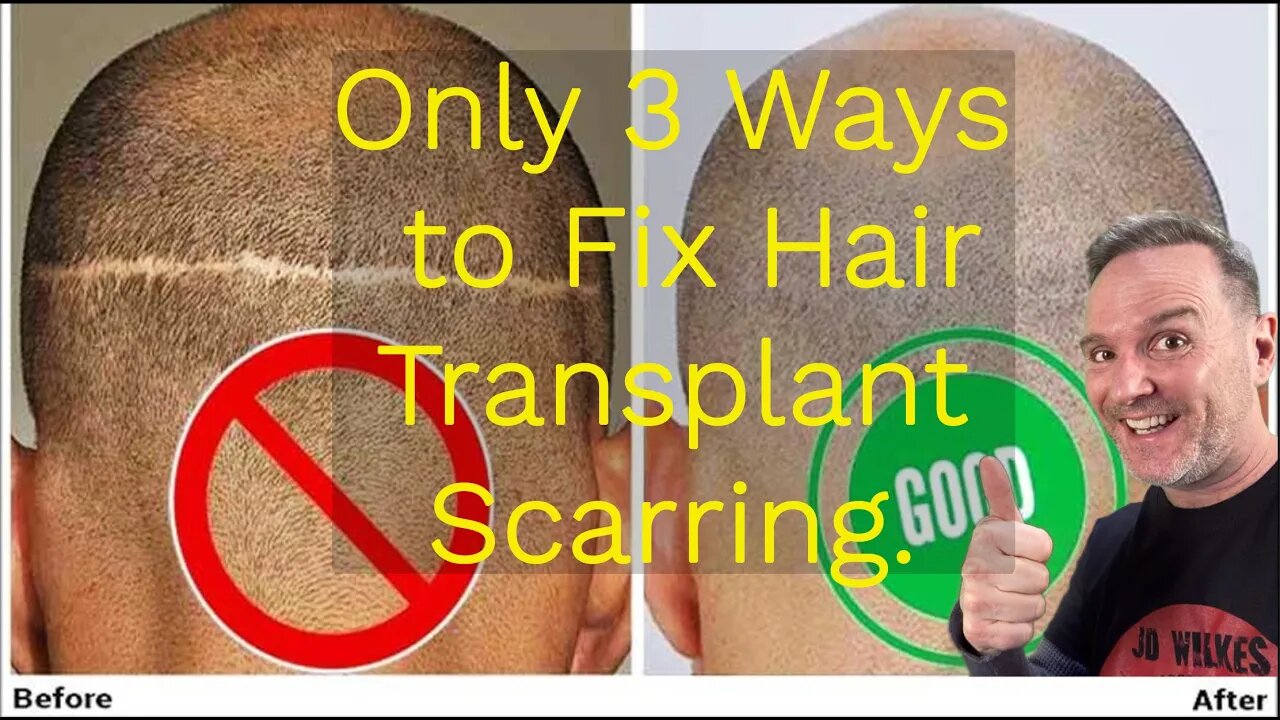 How To Fix Hair Transplant Scars - The Only 3 Ways That Work