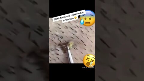 Blackhead & ingrown hair removal 😰🫣 #shorts #blackheadremoval #blackhead #blackheads #extraction