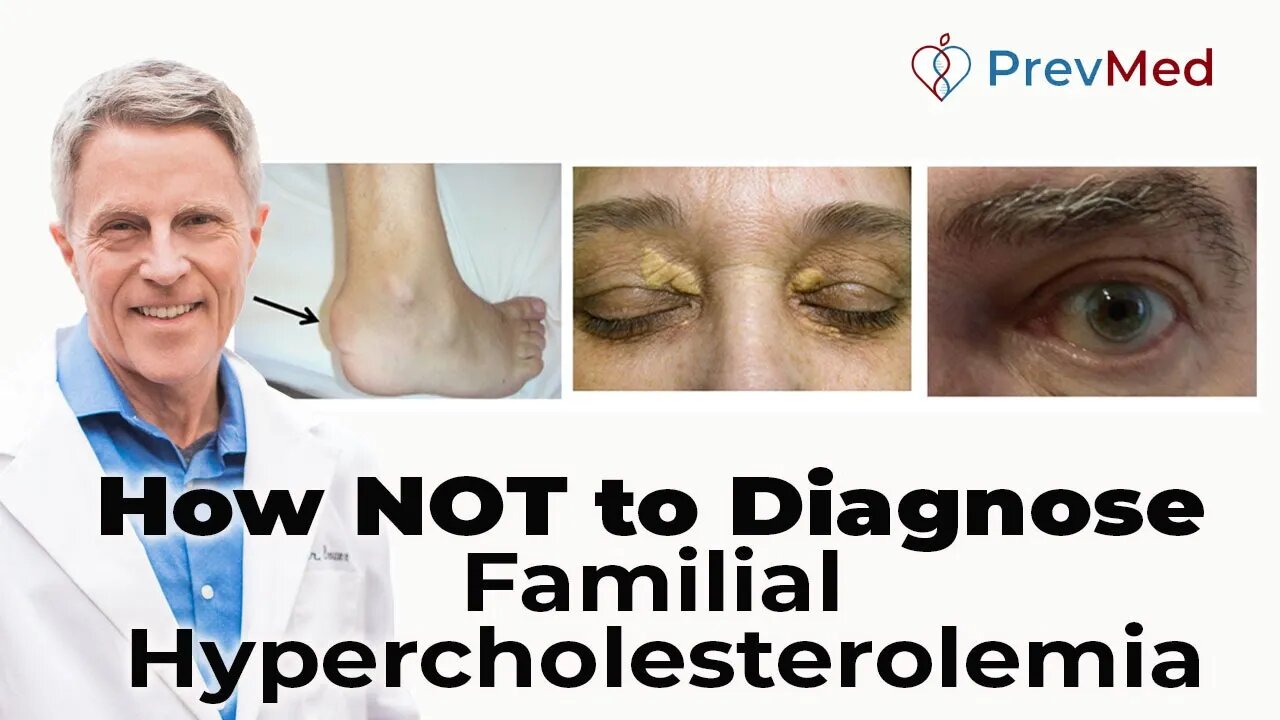 How NOT to Diagnose Familial Hypercholesterolemia