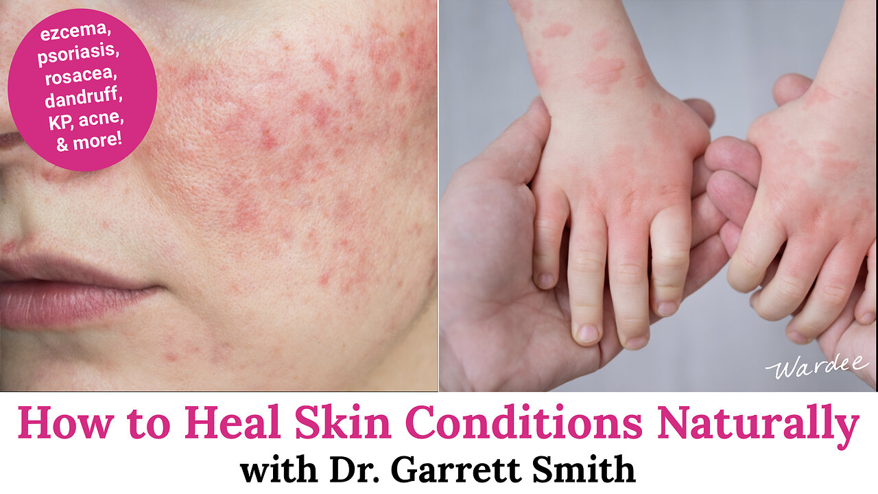 How to Heal Skin Conditions Naturally with Dr. Garrett Smith